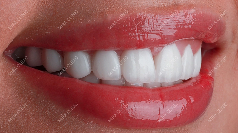 Smile Makeover Patient